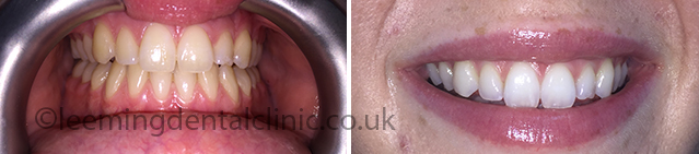 https://leemingdentalclinic.co.uk/wp-content/uploads/2025/07/bleaching-acse.jpg