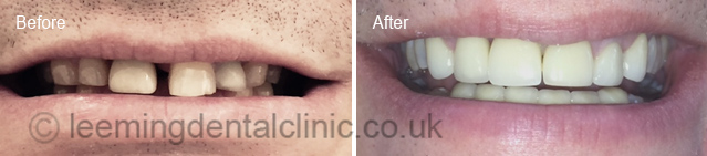 https://leemingdentalclinic.co.uk/wp-content/uploads/2025/07/bridge.jpg