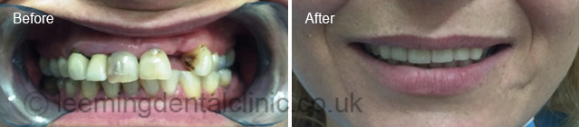 https://leemingdentalclinic.co.uk/wp-content/uploads/2025/07/ceramic-crowns.jpg