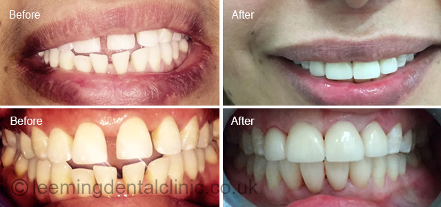 https://leemingdentalclinic.co.uk/wp-content/uploads/2025/07/crowns-1.jpg