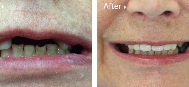 dental-implant-before-after https://leemingdentalclinic.co.uk/wp-content/uploads/2025/07/dental-implant-before-after-640x295.jpg