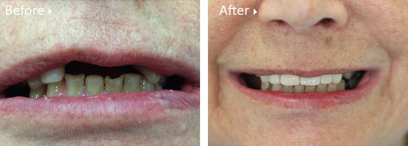 https://leemingdentalclinic.co.uk/wp-content/uploads/2025/07/dental-implant-before-after.jpg