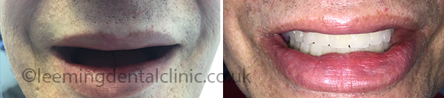 https://leemingdentalclinic.co.uk/wp-content/uploads/2025/07/implants-cosmetic-veneers.jpg