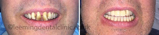 https://leemingdentalclinic.co.uk/wp-content/uploads/2025/07/implants.jpg