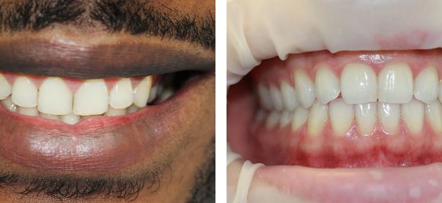 https://leemingdentalclinic.co.uk/wp-content/uploads/2025/07/teeth-whitening-640x295.jpg