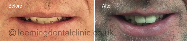 https://leemingdentalclinic.co.uk/wp-content/uploads/2025/07/veneers.jpg